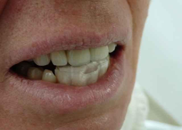 The NTI dental splint is FDA approved and drug free @migrainesavvy